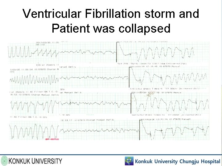 Ventricular Fibrillation storm and Patient was collapsed 