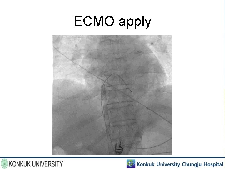 ECMO apply 