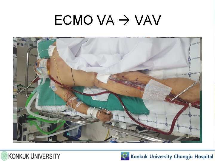 ECMO VA VAV 