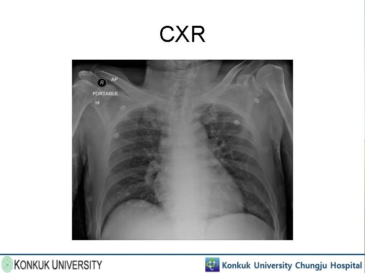 CXR 