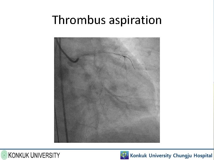 Thrombus aspiration 