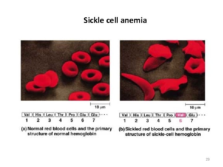 Sickle cell anemia 23 