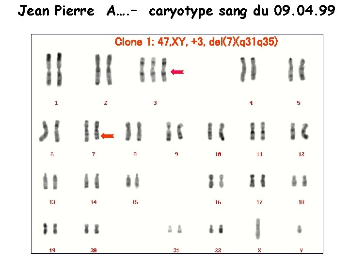 Jean Pierre A…. – caryotype sang du 09. 04. 99 Clone 1: 47, XY, Jean Pierre A…. – caryotype sang du 09. 04. 99 Clone 1: 47, XY,