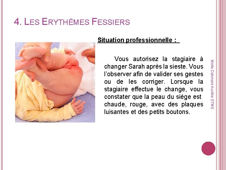 4. LES ERYTHÈMES FESSIERS Situation professionnelle : Melle Dahmani Aurélie STMS Vous autorisez la