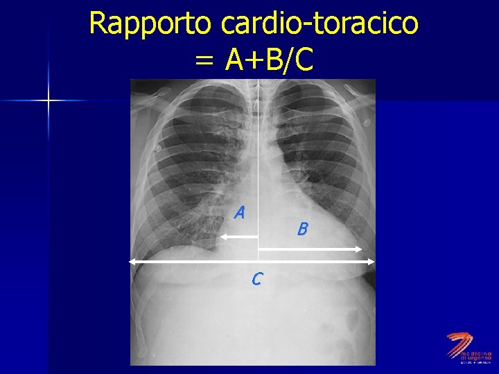 Rapporto cardio-toracico = A+B/C A B C 