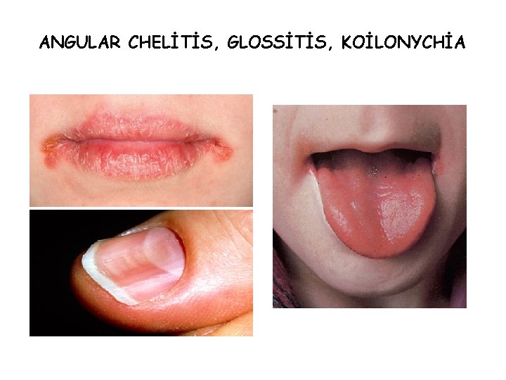 ANGULAR CHELİTİS, GLOSSİTİS, KOİLONYCHİA 