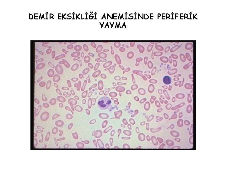 DEMİR EKSİKLİĞİ ANEMİSİNDE PERİFERİK YAYMA 