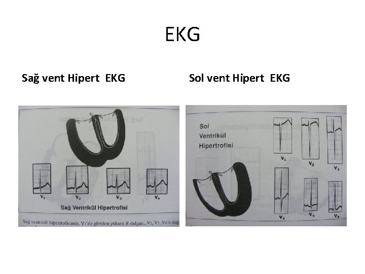 EKG Sağ vent Hipert EKG Sol vent Hipert EKG 