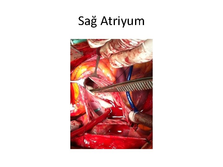 Sağ Atriyum 