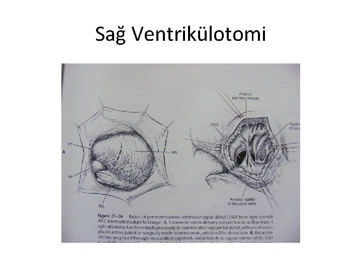Sağ Ventrikülotomi 