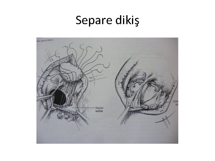 Separe dikiş 