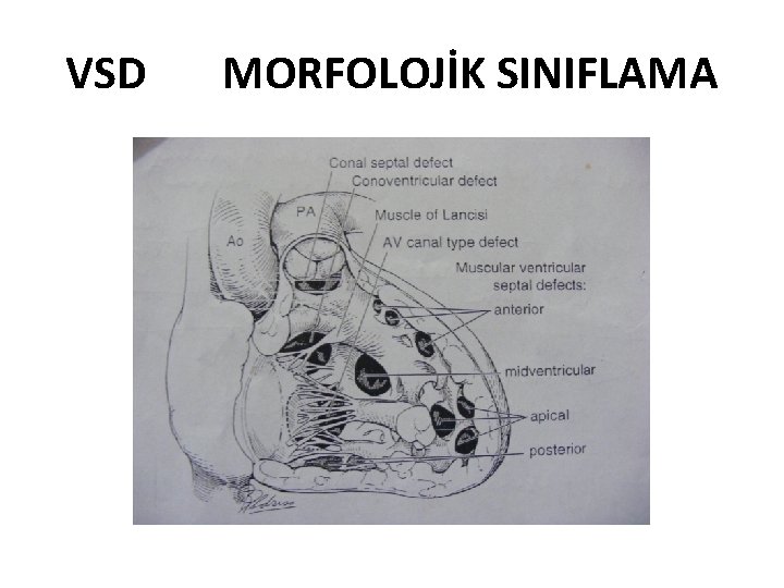VSD MORFOLOJİK SINIFLAMA 