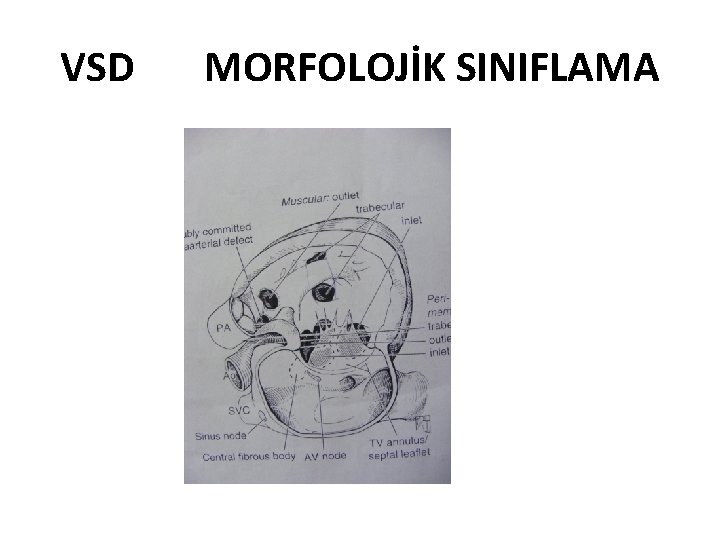 VSD MORFOLOJİK SINIFLAMA 