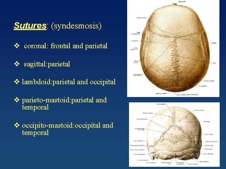 Sutures: (syndesmosis) v coronal: frontal and parietal v sagittal: parietal v lambdoid: parietal and