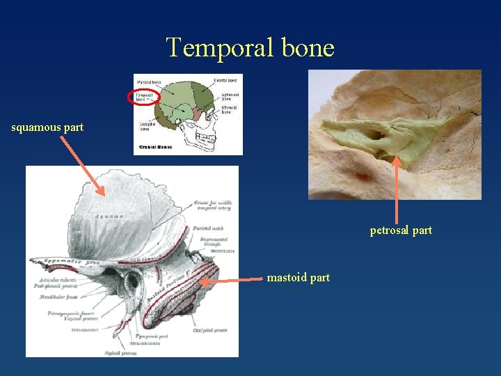 Temporal bone squamous part petrosal part mastoid part 