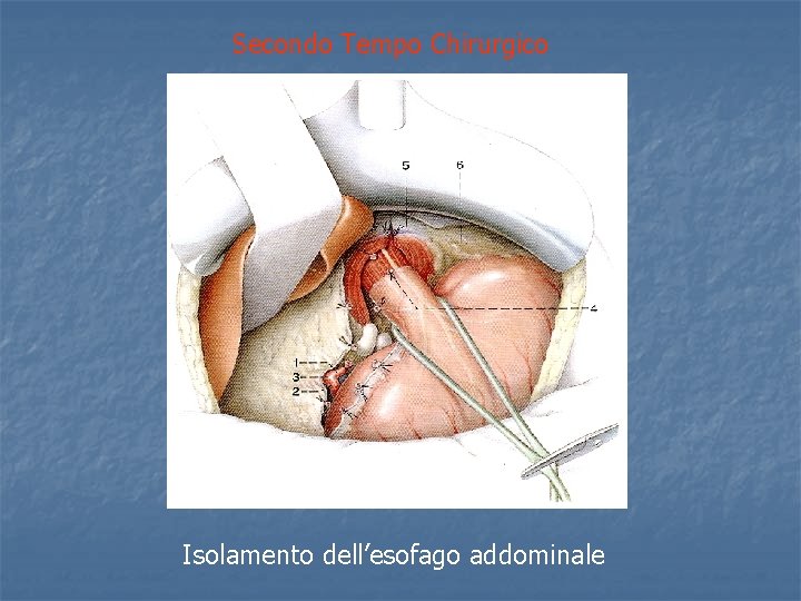 Secondo Tempo Chirurgico Isolamento dell’esofago addominale 