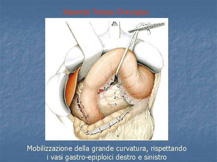Secondo Tempo Chirurgico Mobilizzazione della grande curvatura, rispettando i vasi gastro-epiploici destro e sinistro