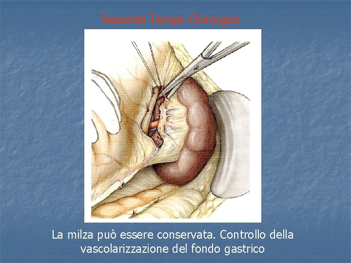 Secondo Tempo Chirurgico La milza può essere conservata. Controllo della vascolarizzazione del fondo gastrico