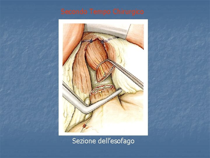Secondo Tempo Chirurgico Sezione dell’esofago 