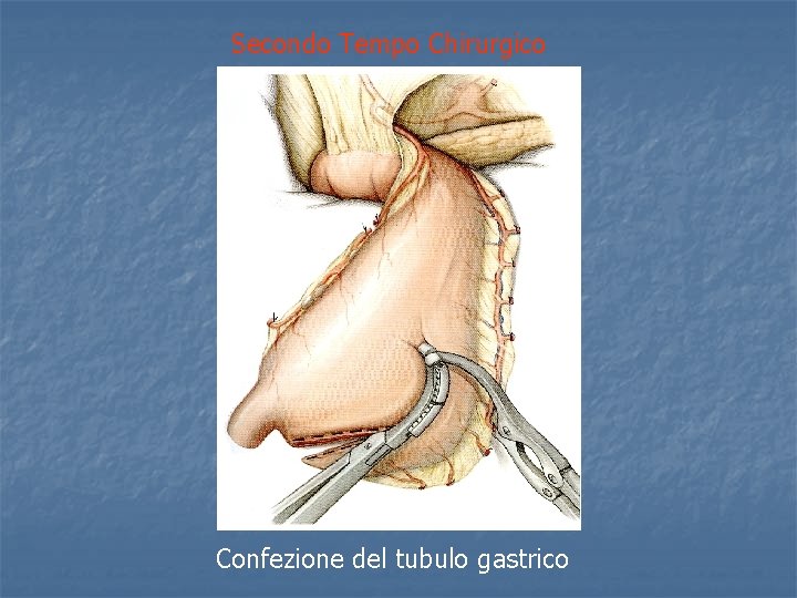 Secondo Tempo Chirurgico Confezione del tubulo gastrico 