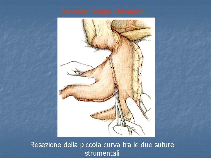 Secondo Tempo Chirurgico Resezione della piccola curva tra le due suture strumentali 