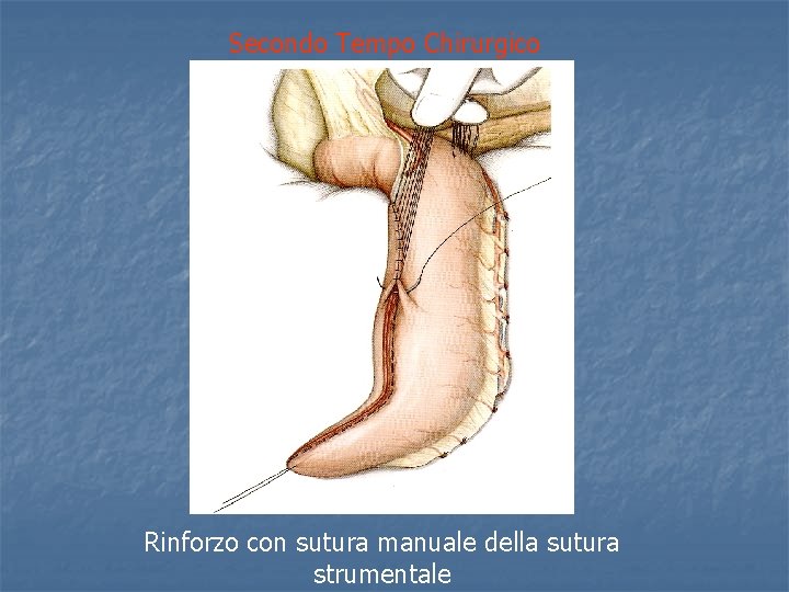 Secondo Tempo Chirurgico Rinforzo con sutura manuale della sutura strumentale 