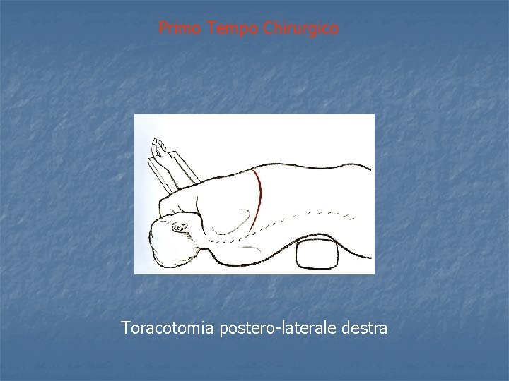 Primo Tempo Chirurgico Toracotomia postero-laterale destra 