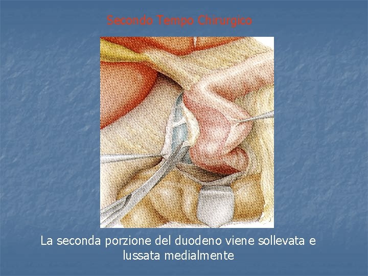 Secondo Tempo Chirurgico La seconda porzione del duodeno viene sollevata e lussata medialmente 