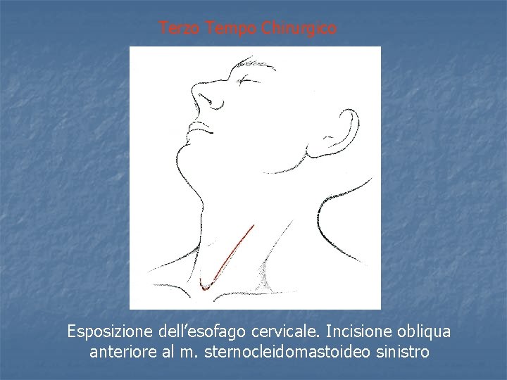 Terzo Tempo Chirurgico Esposizione dell’esofago cervicale. Incisione obliqua anteriore al m. sternocleidomastoideo sinistro 