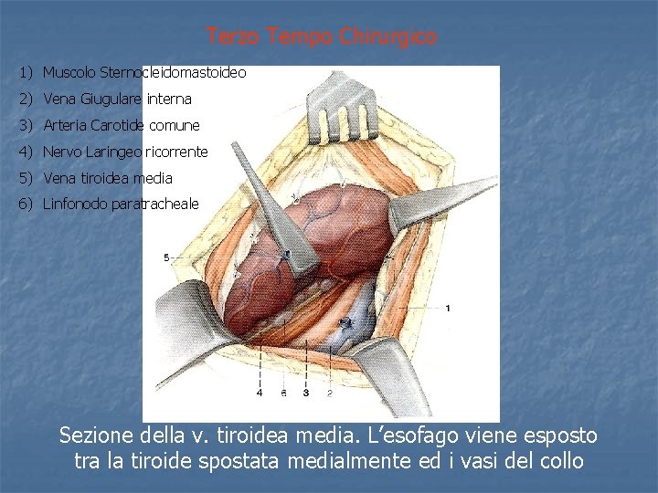 Terzo Tempo Chirurgico 1) Muscolo Sternocleidomastoideo 2) Vena Giugulare interna 3) Arteria Carotide comune