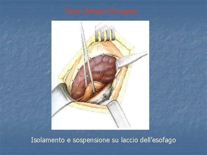 Terzo Tempo Chirurgico Isolamento e sospensione su laccio dell’esofago 