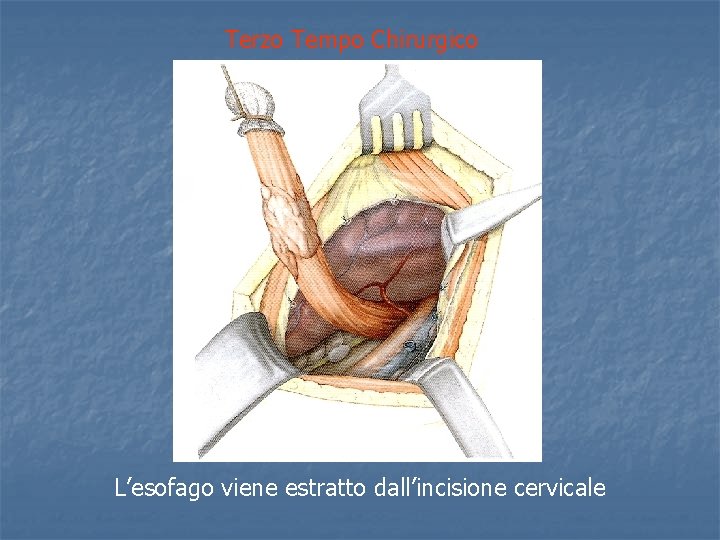 Terzo Tempo Chirurgico L’esofago viene estratto dall’incisione cervicale 