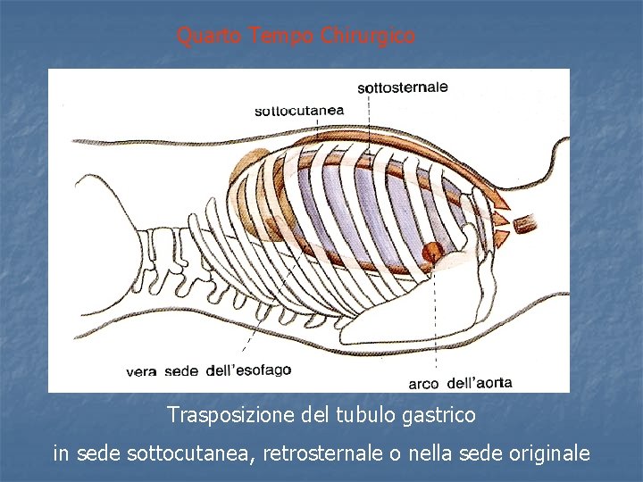 Quarto Tempo Chirurgico Trasposizione del tubulo gastrico in sede sottocutanea, retrosternale o nella sede