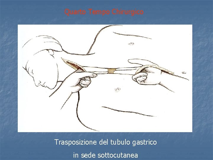 Quarto Tempo Chirurgico Trasposizione del tubulo gastrico in sede sottocutanea 