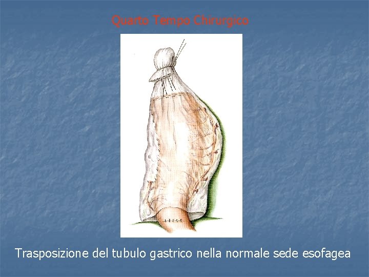 Quarto Tempo Chirurgico Trasposizione del tubulo gastrico nella normale sede esofagea 