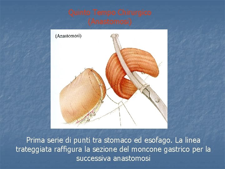 Quinto Tempo Chirurgico (Anastomosi) Prima serie di punti tra stomaco ed esofago. La linea