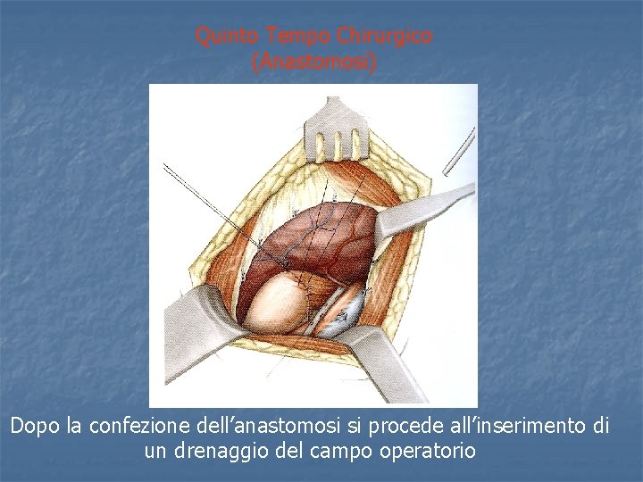 Quinto Tempo Chirurgico (Anastomosi) Dopo la confezione dell’anastomosi si procede all’inserimento di un drenaggio