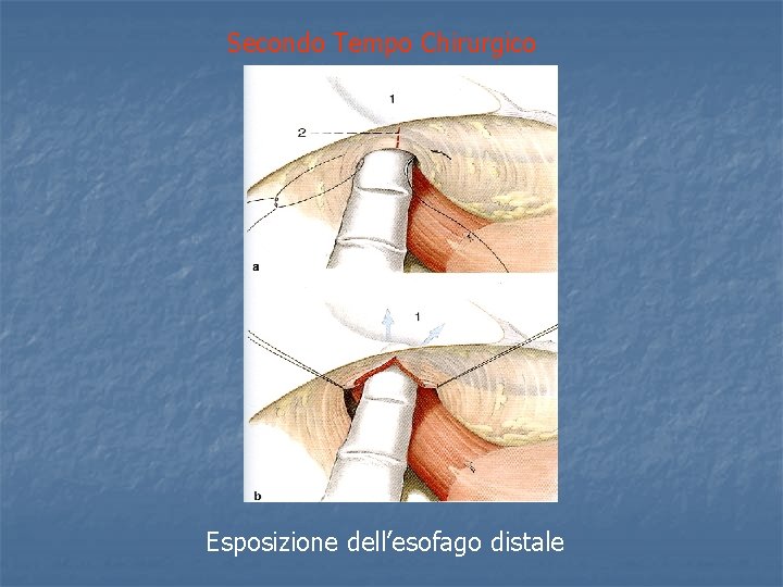 Secondo Tempo Chirurgico Esposizione dell’esofago distale 