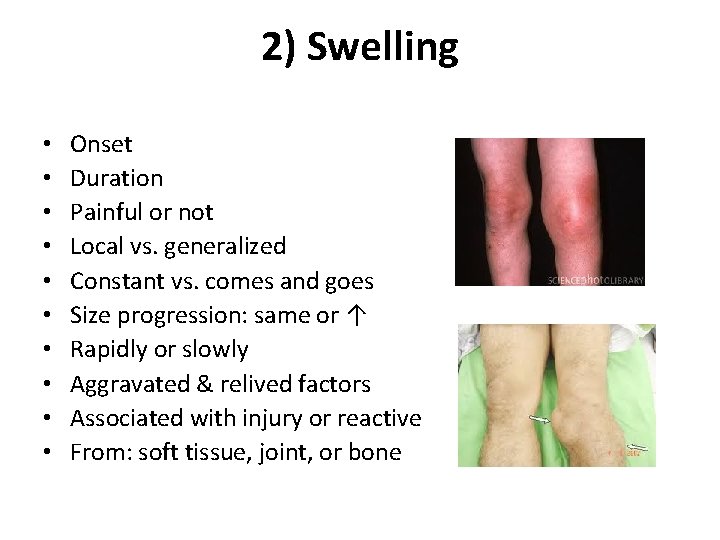 2) Swelling • • • Onset Duration Painful or not Local vs. generalized Constant