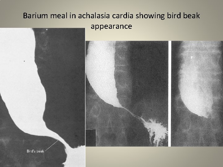 Barium meal in achalasia cardia showing bird beak appearance 