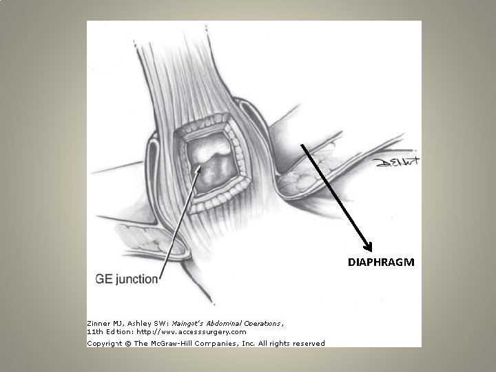 DIAPHRAGM 