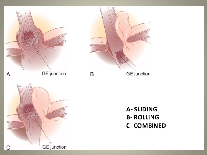 A- SLIDING B- ROLLING C- COMBINED 