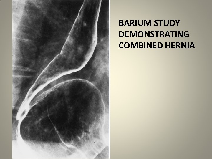 BARIUM STUDY DEMONSTRATING COMBINED HERNIA 