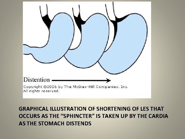 GRAPHICAL ILLUSTRATION OF SHORTENING OF LES THAT OCCURS AS THE “SPHINCTER” IS TAKEN UP
