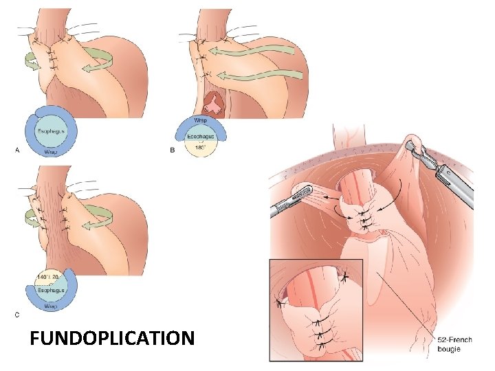 FUNDOPLICATION 
