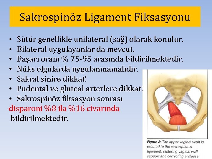 Sakrospinöz Ligament Fiksasyonu • Sütür genellikle unilateral (sağ) olarak konulur. • Bilateral uygulayanlar da