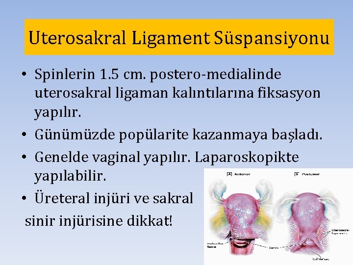 Uterosakral Ligament Süspansiyonu • Spinlerin 1. 5 cm. postero-medialinde uterosakral ligaman kalıntılarına fiksasyon yapılır.