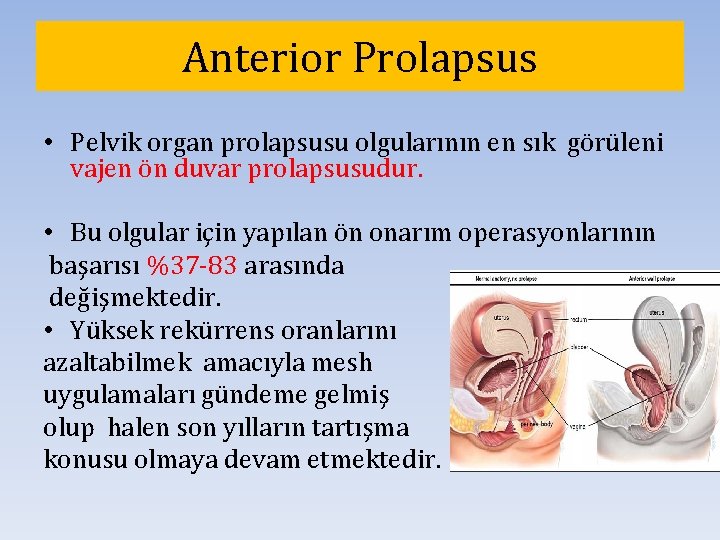 Anterior Prolapsus • Pelvik organ prolapsusu olgularının en sık görüleni vajen ön duvar prolapsusudur.