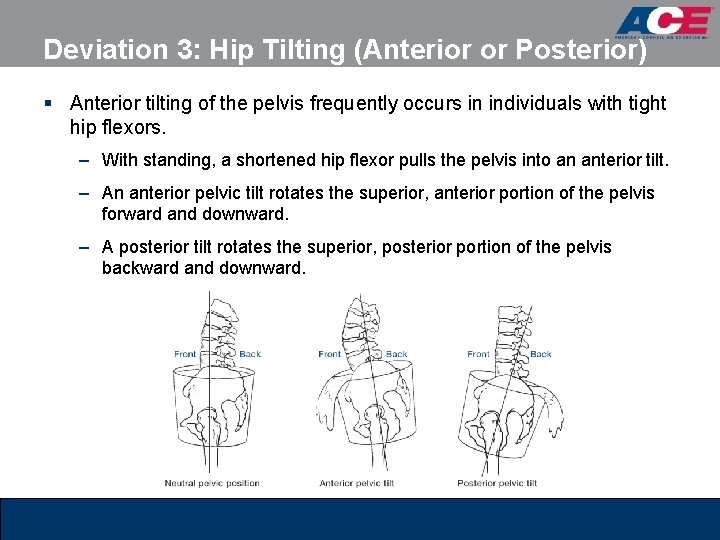 Deviation 3: Hip Tilting (Anterior or Posterior) § Anterior tilting of the pelvis frequently