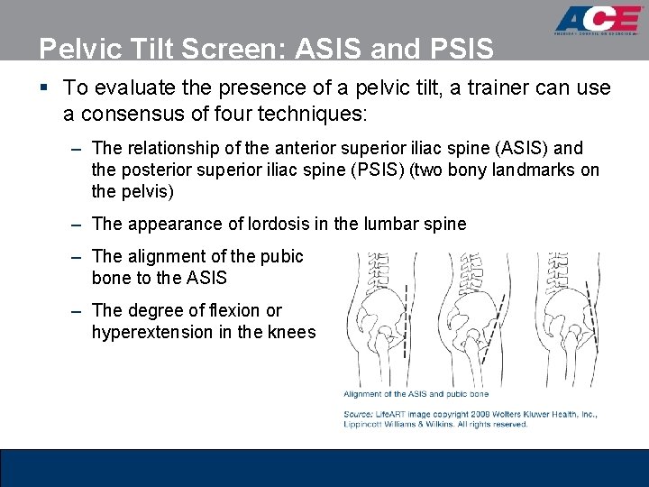 Pelvic Tilt Screen: ASIS and PSIS § To evaluate the presence of a pelvic